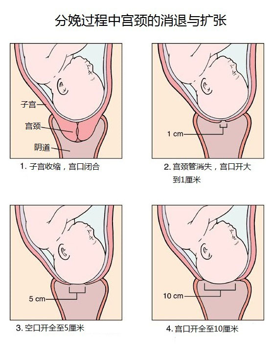 分娩过程中 宫颈变化